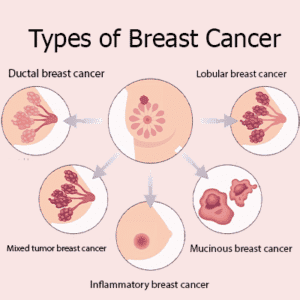 types of breast cancer
