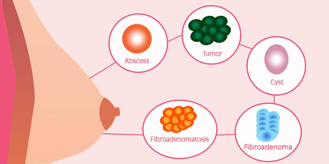 Most Common Breast Masses - Comparison between Fibroadenoma