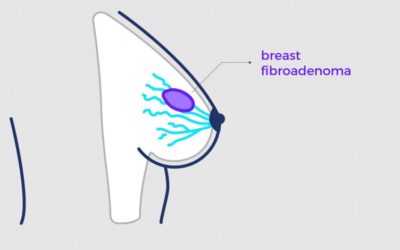 WHAT ARE FIBROADENOMAS?