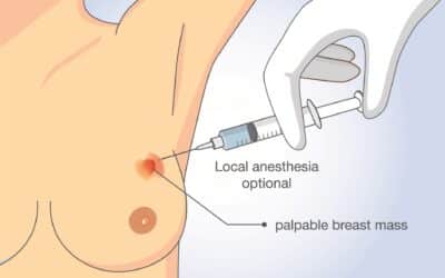 What is a Biopsy and Why is it Done?