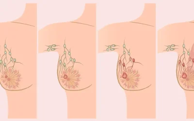 Understanding Breast Cancer Staging: Predicting Cure Chances and Treatment Options