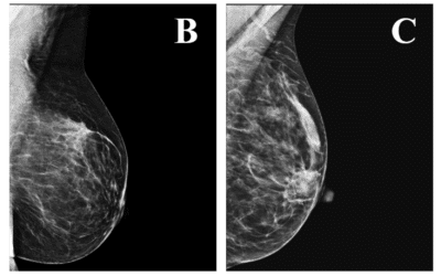 Understanding BI-RADS: A Crucial Tool in Breast Cancer Detection
