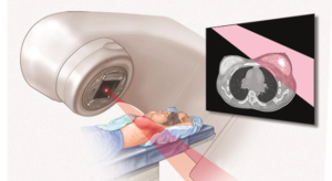 Radiation Therapy – Breast Cancer Care