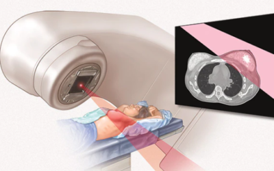 Radiation Therapy – Breast Cancer Care