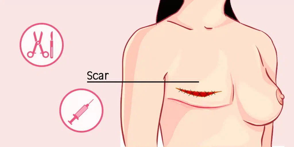 Breast Cancer Post-Surgery Changes to Body