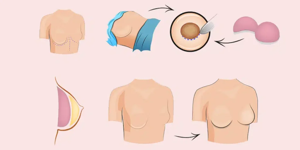 Breast Reconstruction