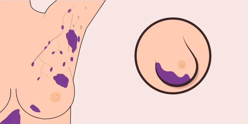 Stage 2 of Breast Cancer Recovered