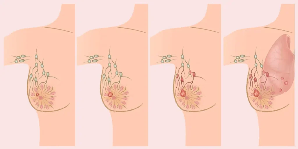 Stages of Breast Cancer