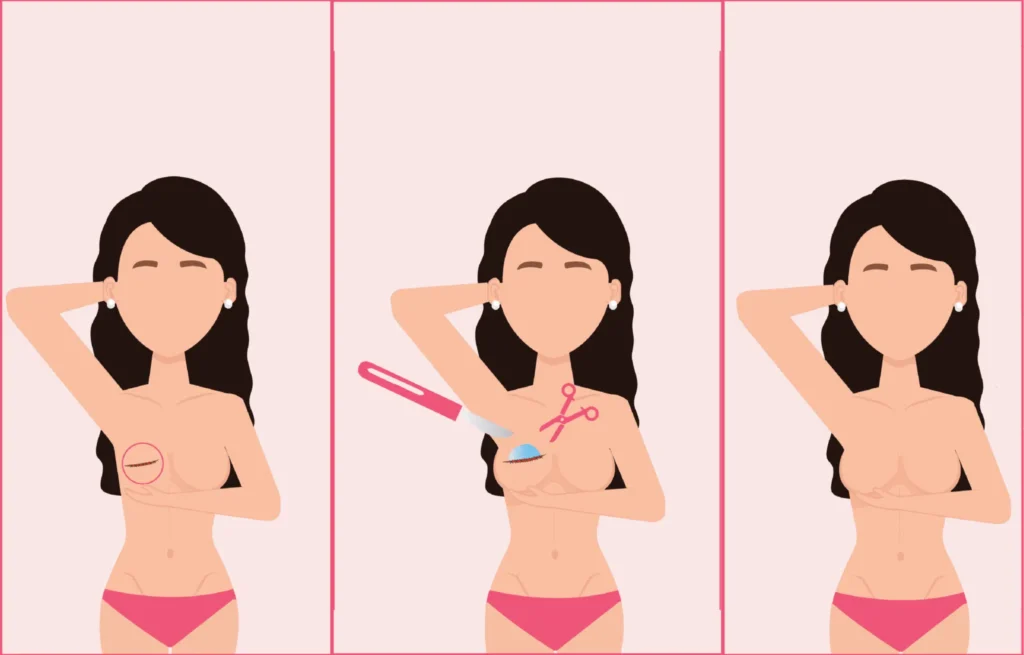The Breast Reconstruction Procedure