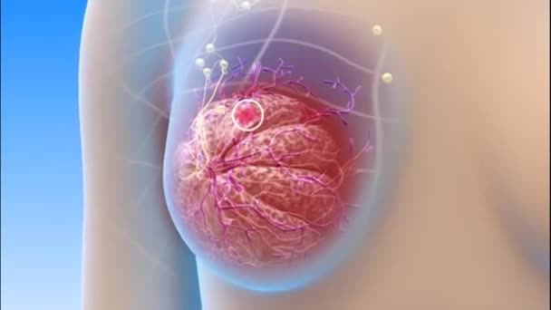 Breast Cancer - Ultrasound