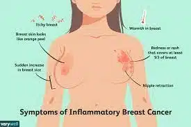 symptoms of inflammatory breast cancer