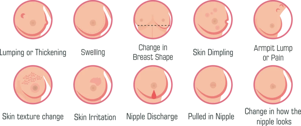 Warning Signs of Breast Cancer That a Woman Should Never Ignore
