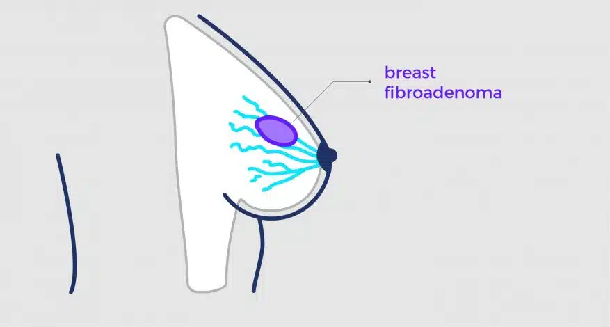 What Are Fibroadenomas