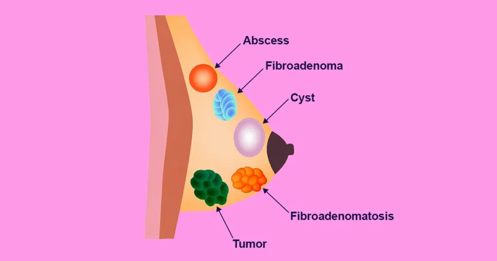 Benign Diseases of Breast