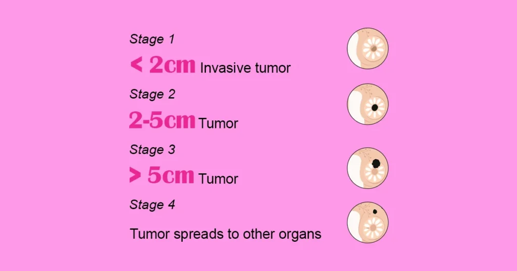 Stages of Breast Cancer