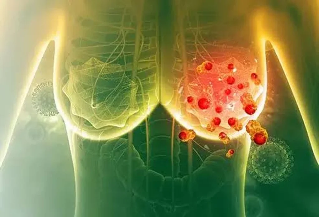 Stage 2 of Breast Cancer Recovered