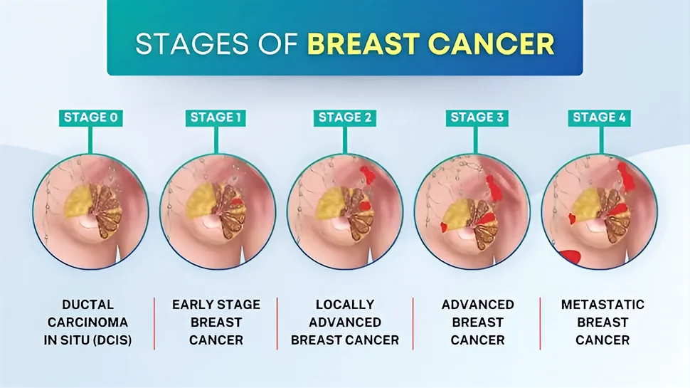 types of breast cancer